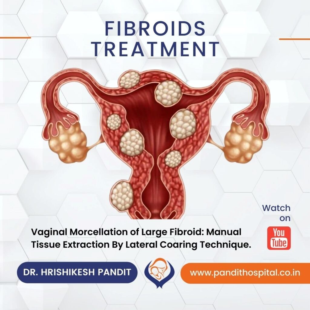 large uetrine fibroid removal by vaginal morcellation