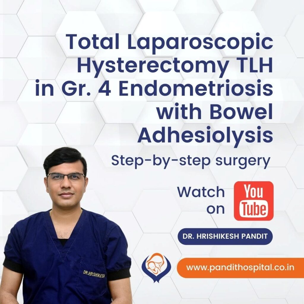 Total Laparoscopic Hysterectomy TLH in endometriosis by Dr. Hrishikesh Pandit