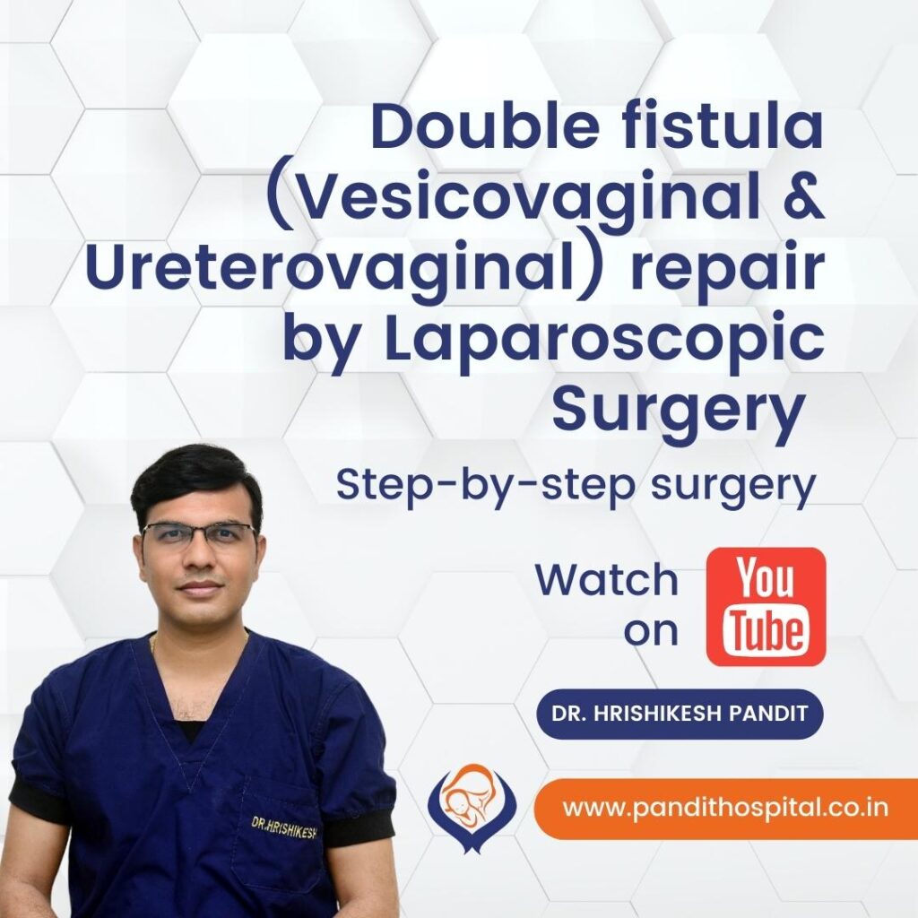 Double fistula repair by Laparoscopic Surgery by Dr. Hrishikesh Pandit
