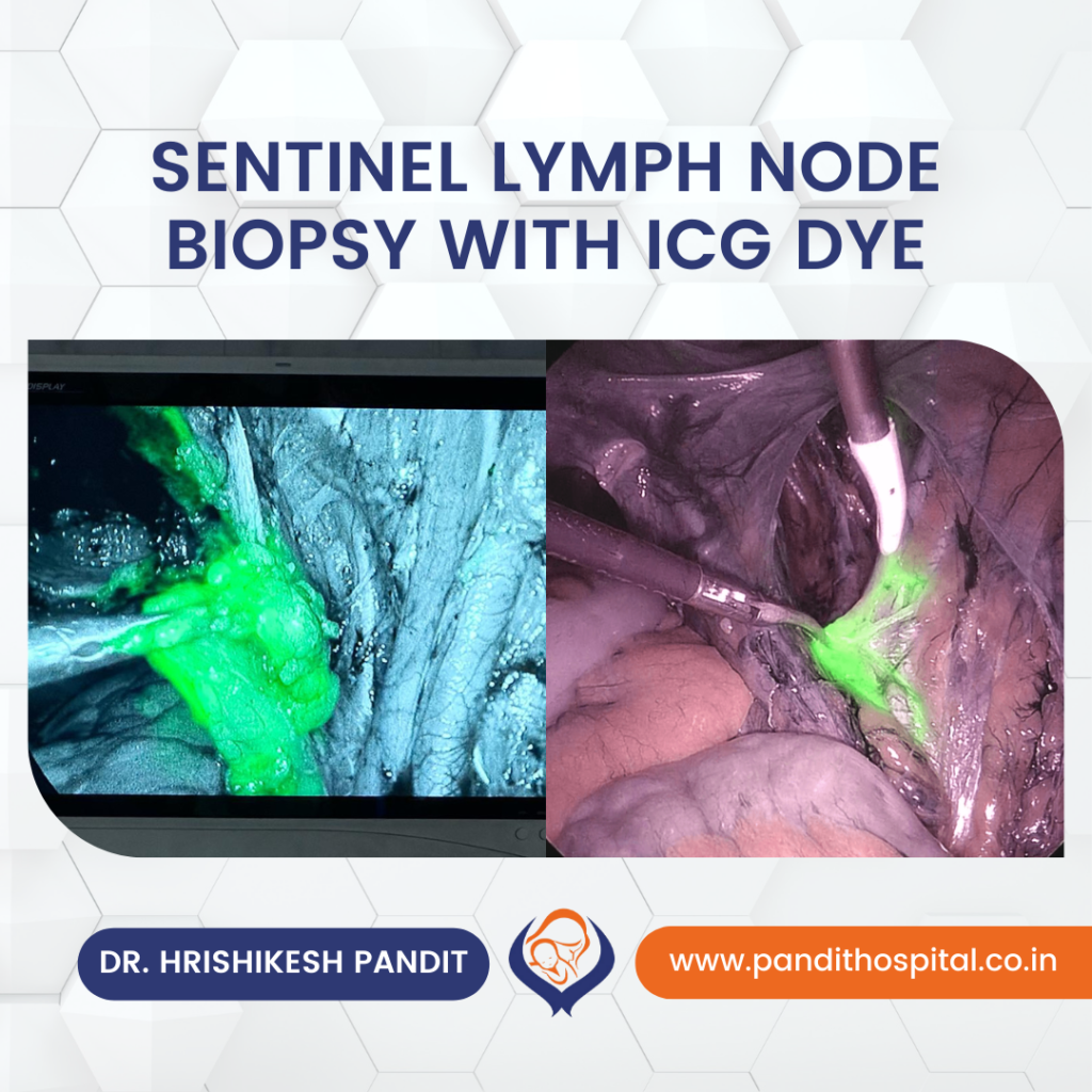 Sentinel Lymph Node Biopsy with ICG Dye in Ahmednagar